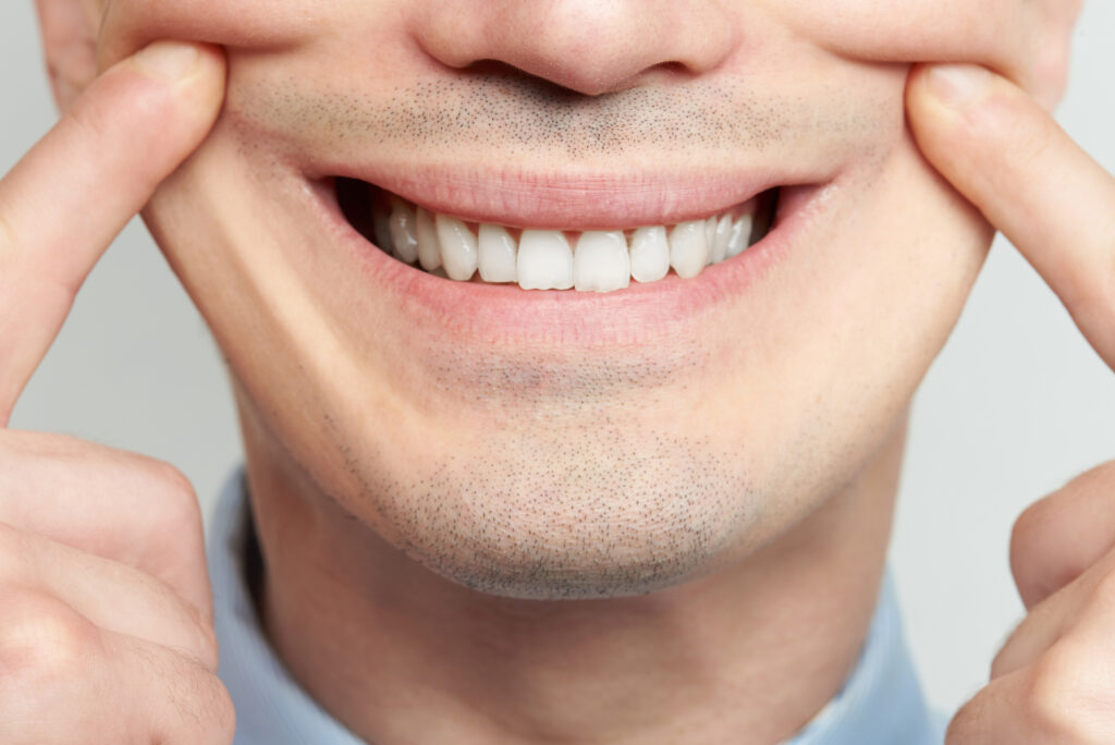 Man forcing himself to smile.  Represents people-pleasing which is a symptom of complex post traumatic stress disorder.